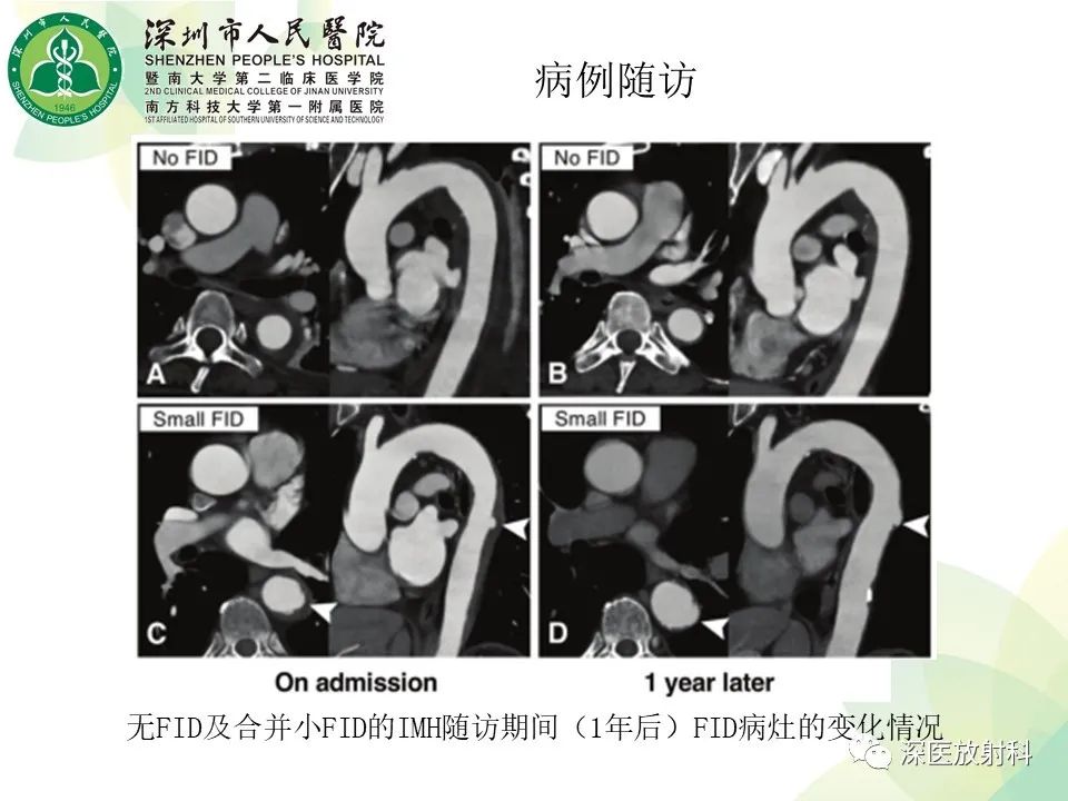 影像PPT - 【PPT】B型主动脉壁内血肿多层螺旋CT局灶性内膜破裂大小与疾病进展的关系-17