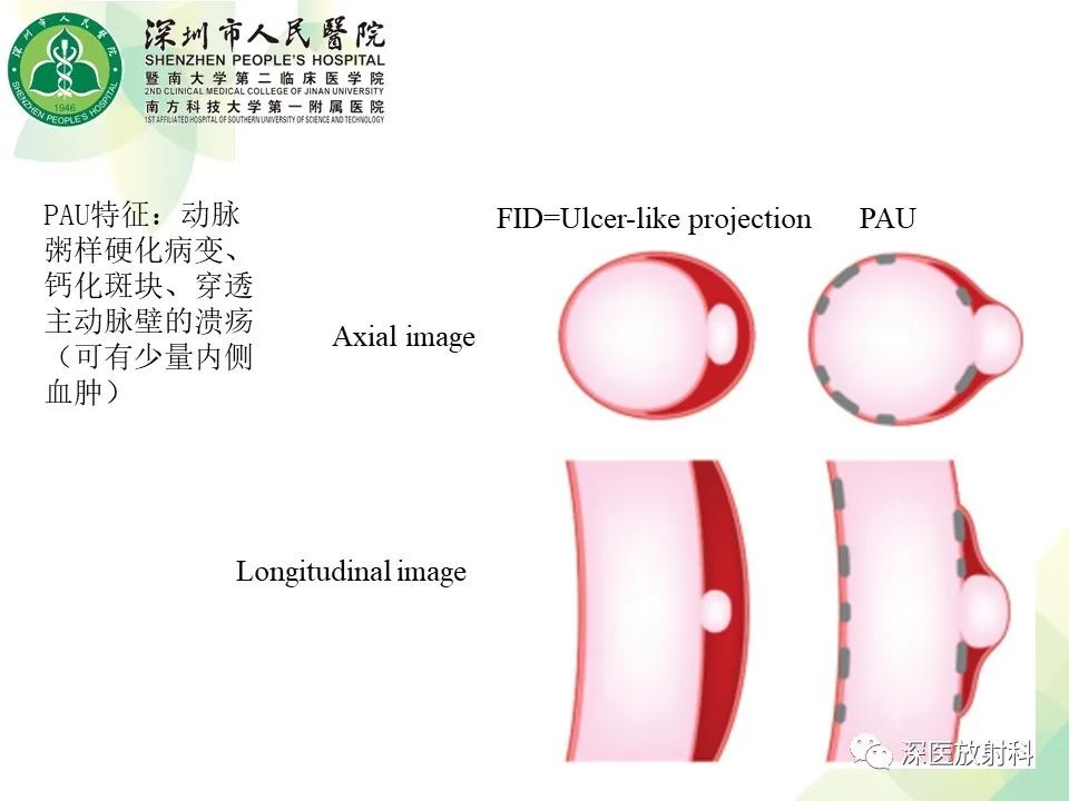 影像PPT - 【PPT】B型主动脉壁内血肿多层螺旋CT局灶性内膜破裂大小与疾病进展的关系-14