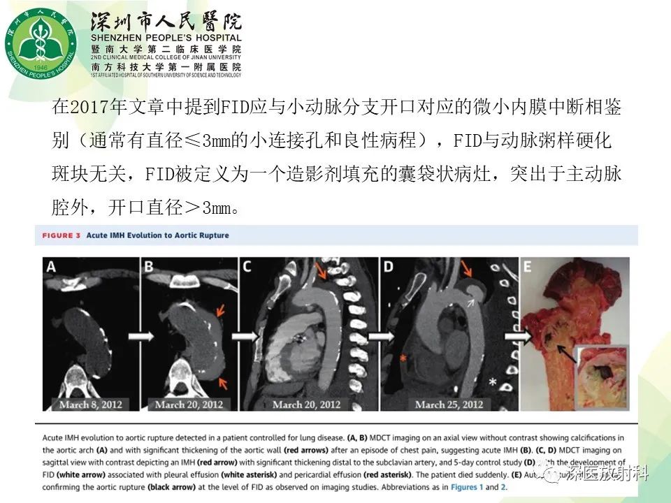 影像PPT - 【PPT】B型主动脉壁内血肿多层螺旋CT局灶性内膜破裂大小与疾病进展的关系-35