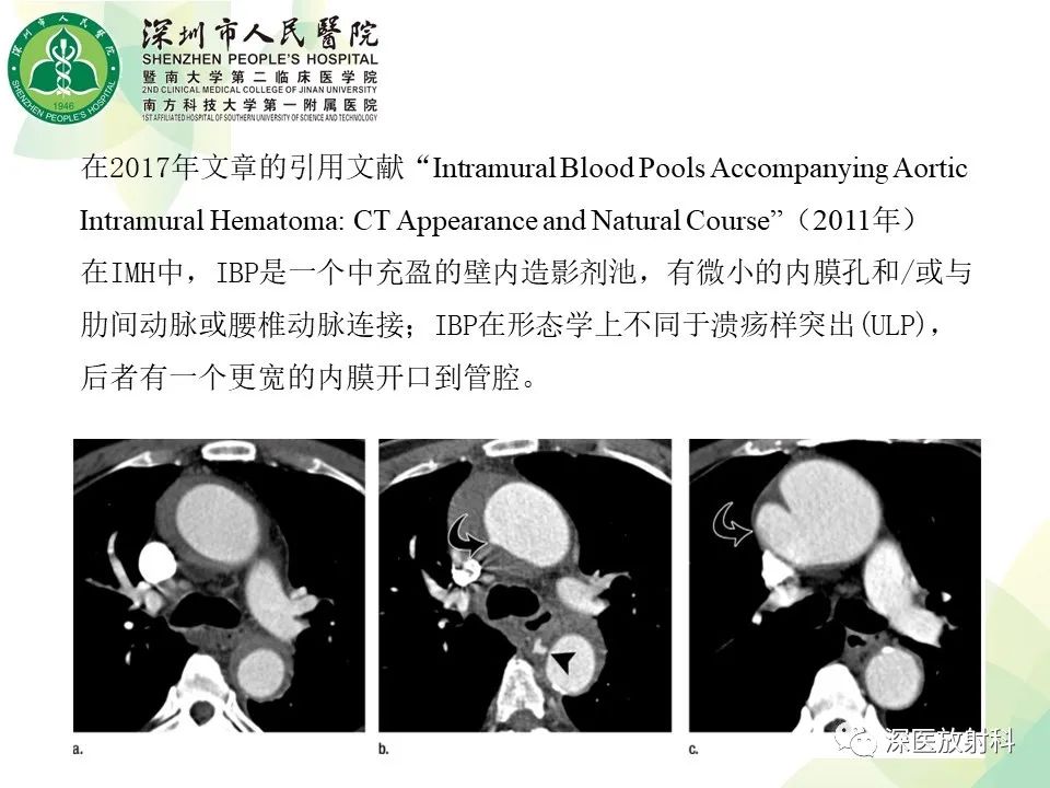 影像PPT - 【PPT】B型主动脉壁内血肿多层螺旋CT局灶性内膜破裂大小与疾病进展的关系-39