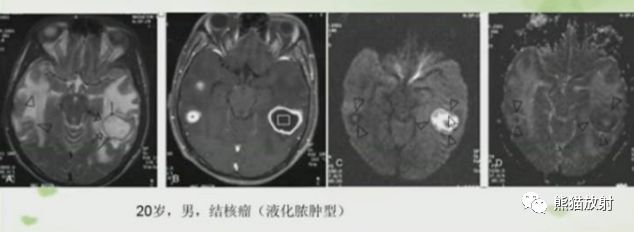 影像PPT - 影像征象—多脏器之“牛眼征“(”靶征“)-10 影像PPT - 影像征象—多脏器之“牛眼征“(”靶征“)-10