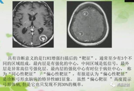 影像PPT - 影像征象—多脏器之“牛眼征“(”靶征“)-9 影像PPT - 影像征象—多脏器之“牛眼征“(”靶征“)-9
