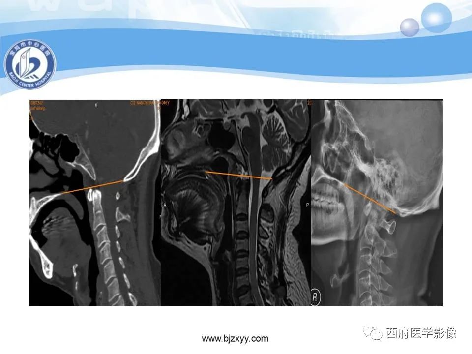 影像PPT - 【PPT】颅底凹陷症的影像诊断-11