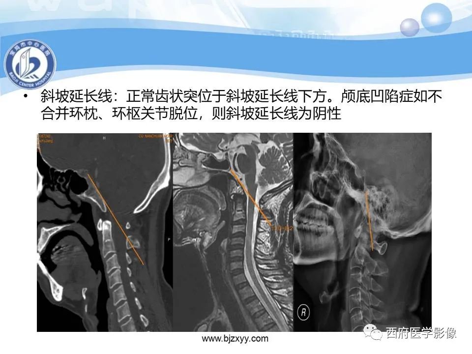 影像PPT - 【PPT】颅底凹陷症的影像诊断-13