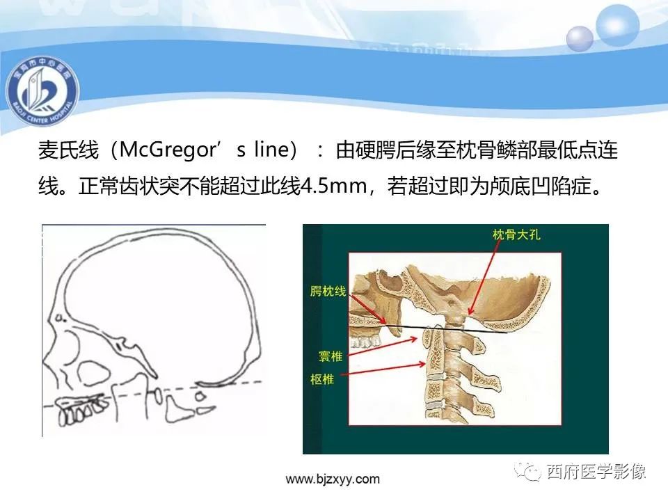 影像PPT - 【PPT】颅底凹陷症的影像诊断-12