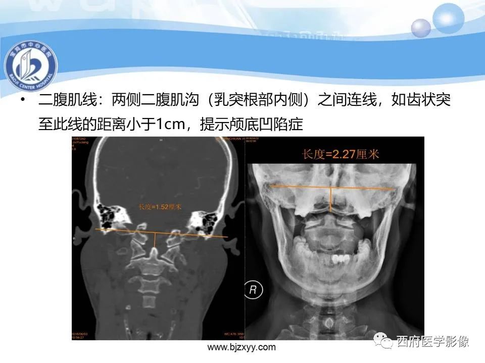 影像PPT - 【PPT】颅底凹陷症的影像诊断-15