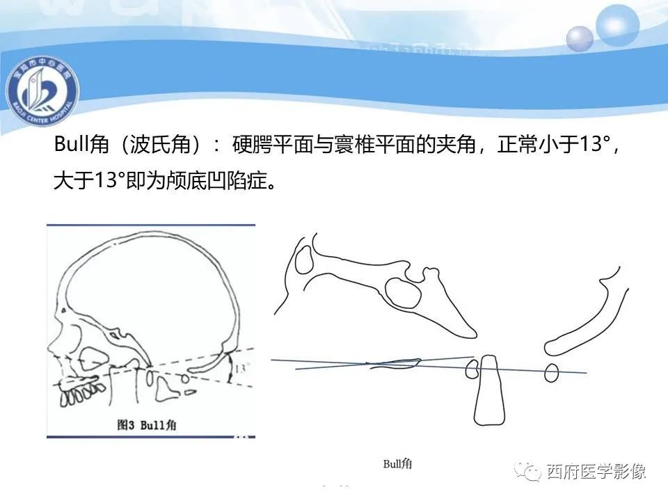影像PPT - 【PPT】颅底凹陷症的影像诊断-17