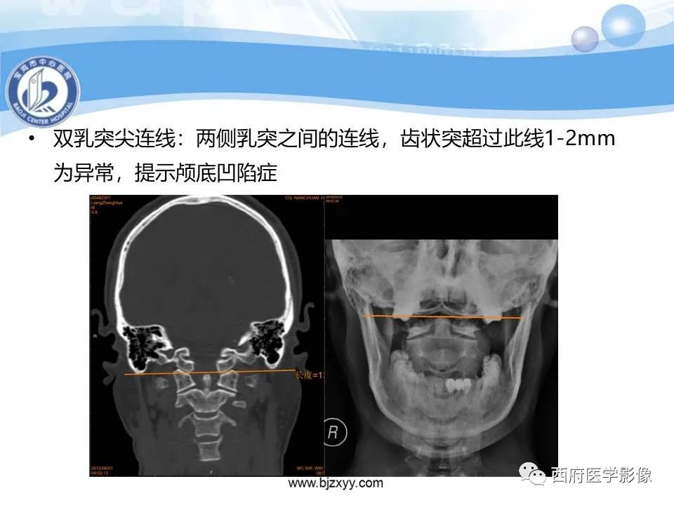 影像PPT - 【PPT】颅底凹陷症的影像诊断-16