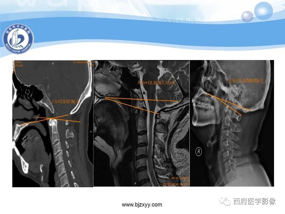 影像PPT - 【PPT】颅底凹陷症的影像诊断-18