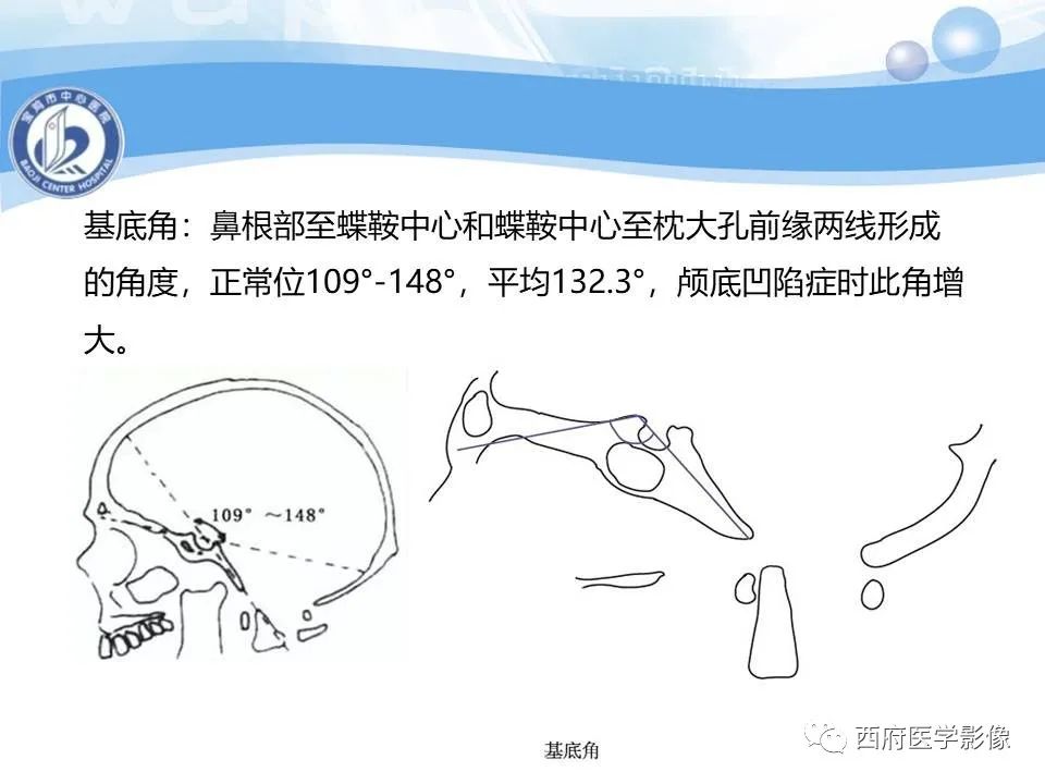 影像PPT - 【PPT】颅底凹陷症的影像诊断-19