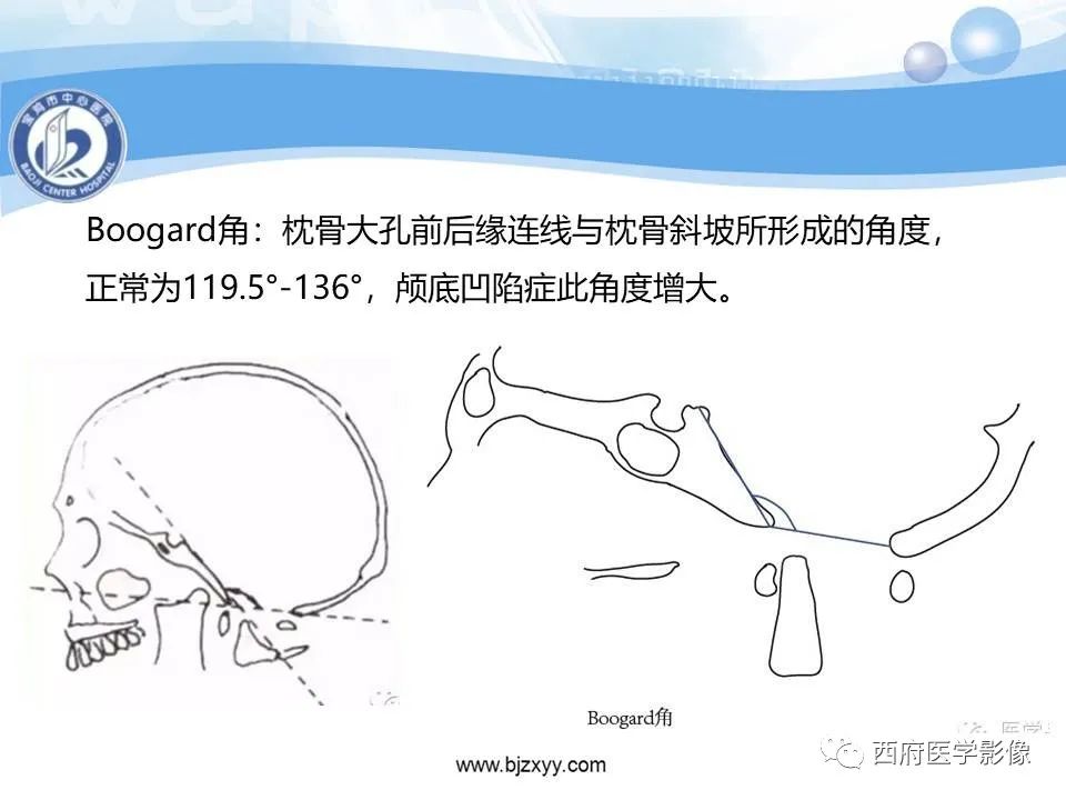 影像PPT - 【PPT】颅底凹陷症的影像诊断-21