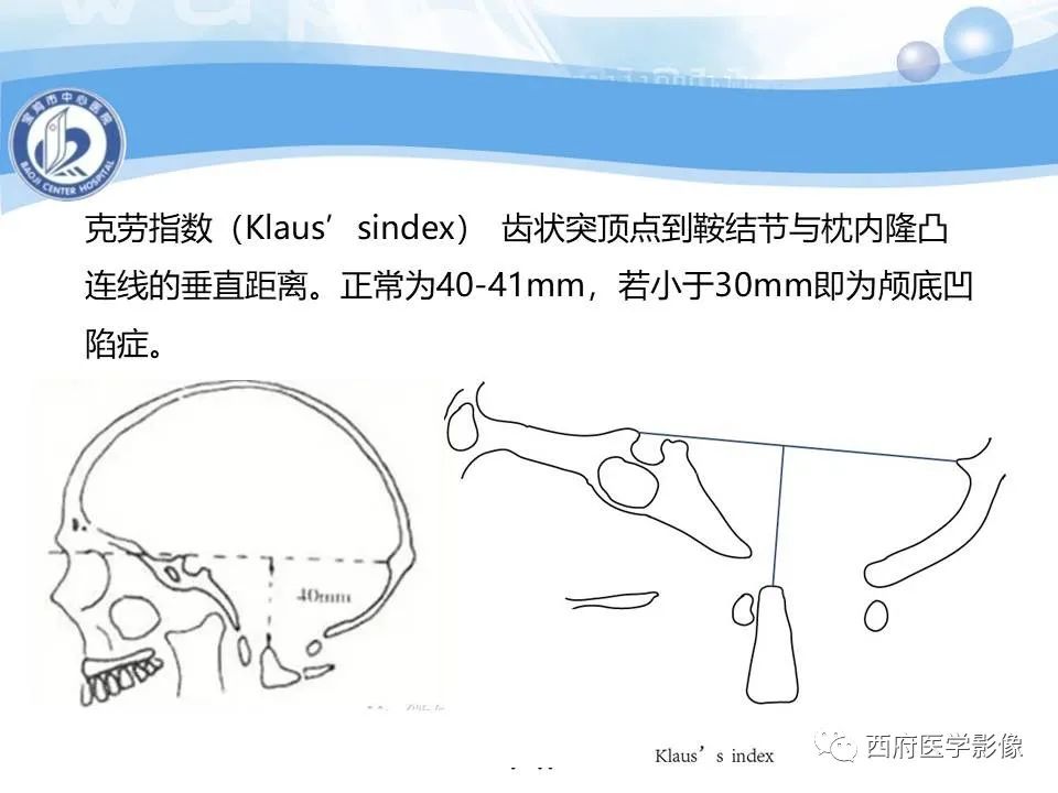 影像PPT - 【PPT】颅底凹陷症的影像诊断-23