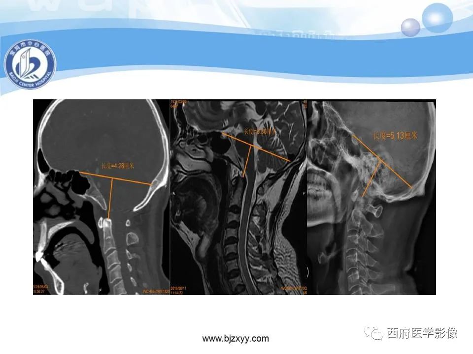 影像PPT - 【PPT】颅底凹陷症的影像诊断-24