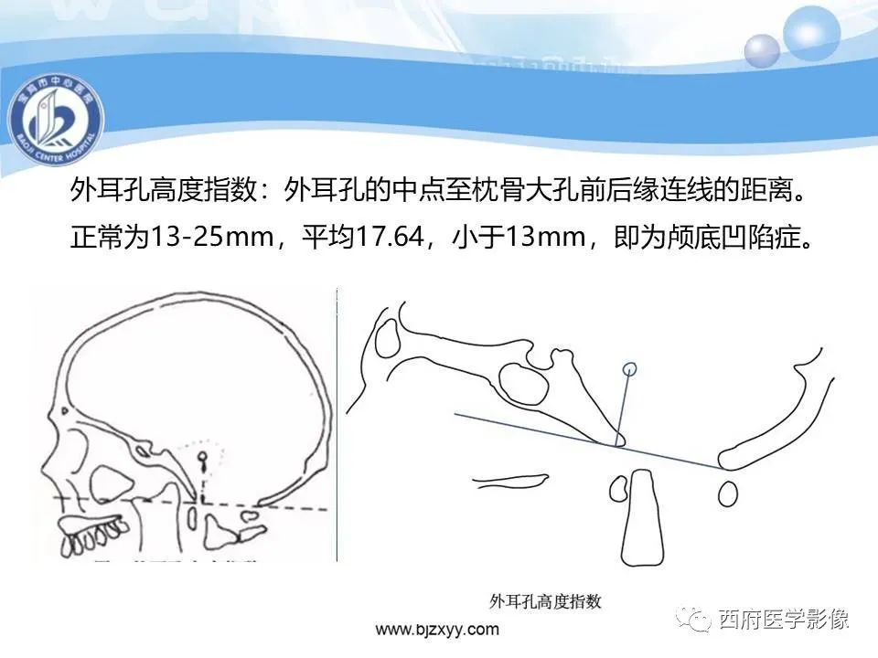 影像PPT - 【PPT】颅底凹陷症的影像诊断-25