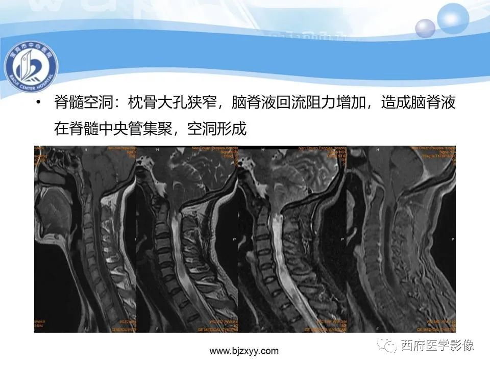 影像PPT - 【PPT】颅底凹陷症的影像诊断-29