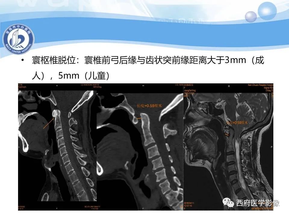影像PPT - 【PPT】颅底凹陷症的影像诊断-27