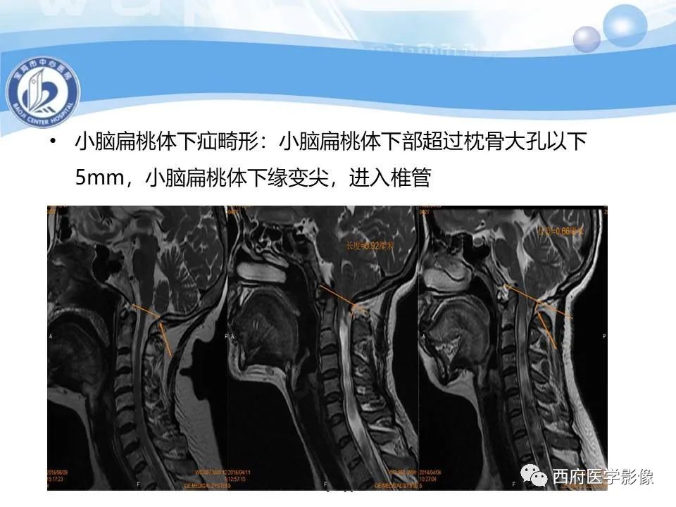 影像PPT - 【PPT】颅底凹陷症的影像诊断-28