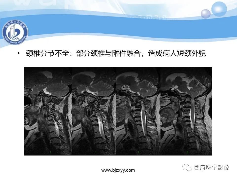 影像PPT - 【PPT】颅底凹陷症的影像诊断-31