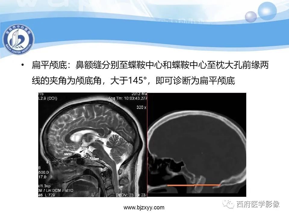 影像PPT - 【PPT】颅底凹陷症的影像诊断-32