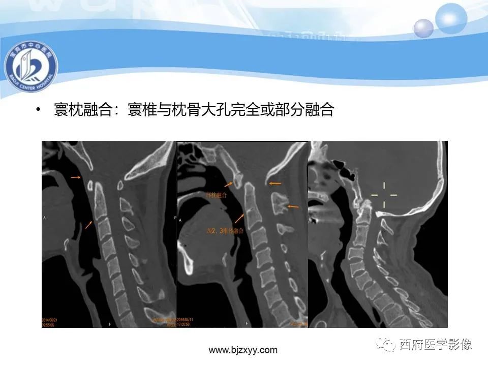 影像PPT - 【PPT】颅底凹陷症的影像诊断-30