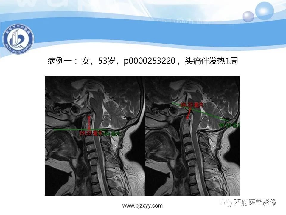 影像PPT - 【PPT】颅底凹陷症的影像诊断-34