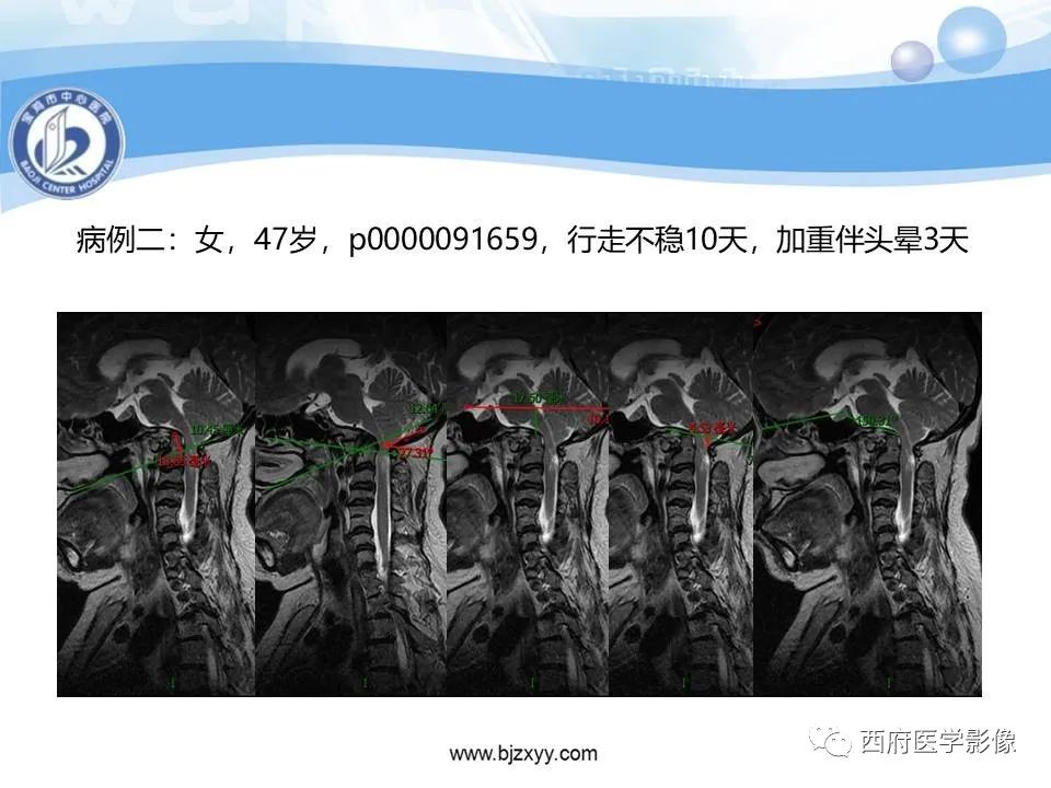 影像PPT - 【PPT】颅底凹陷症的影像诊断-35