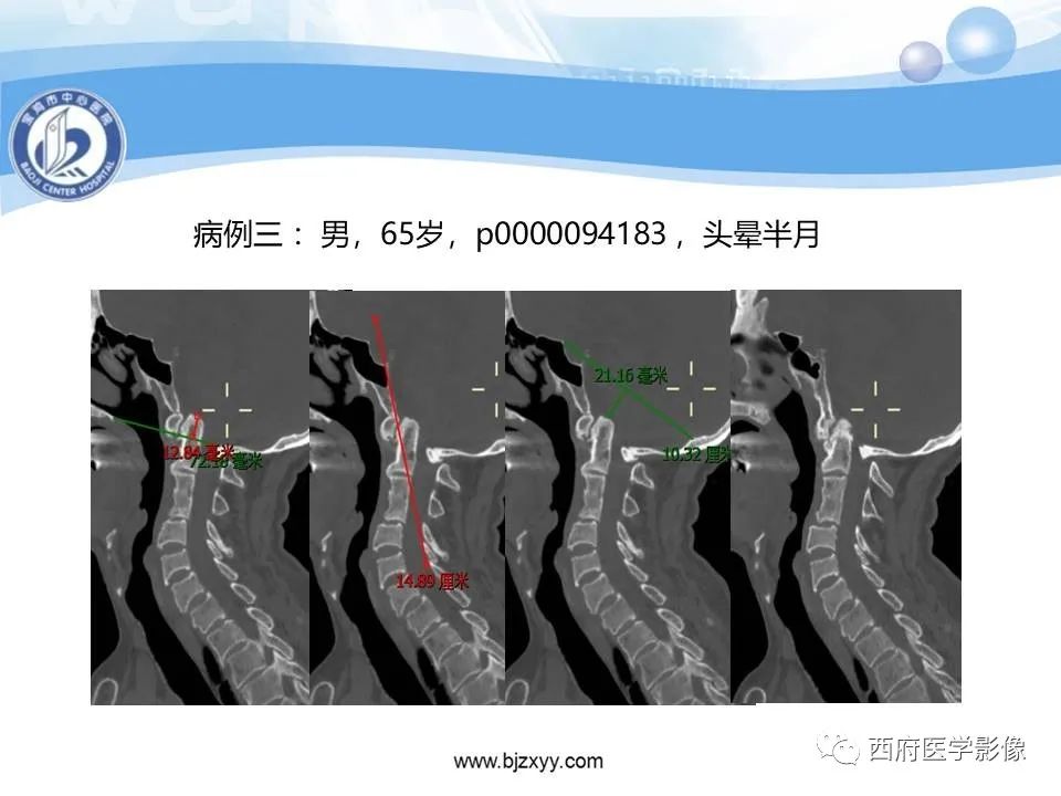 影像PPT - 【PPT】颅底凹陷症的影像诊断-36