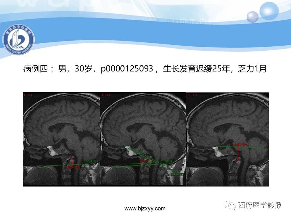 影像PPT - 【PPT】颅底凹陷症的影像诊断-37