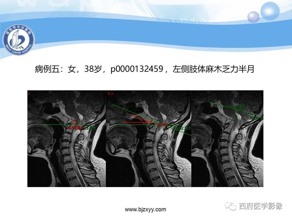 影像PPT - 【PPT】颅底凹陷症的影像诊断-38