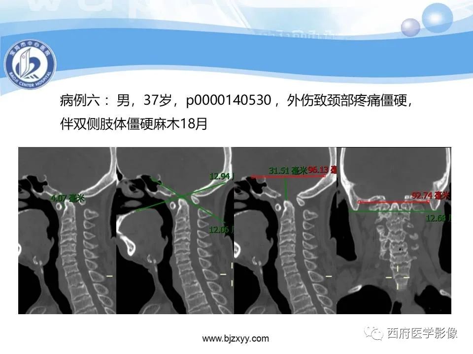 影像PPT - 【PPT】颅底凹陷症的影像诊断-39