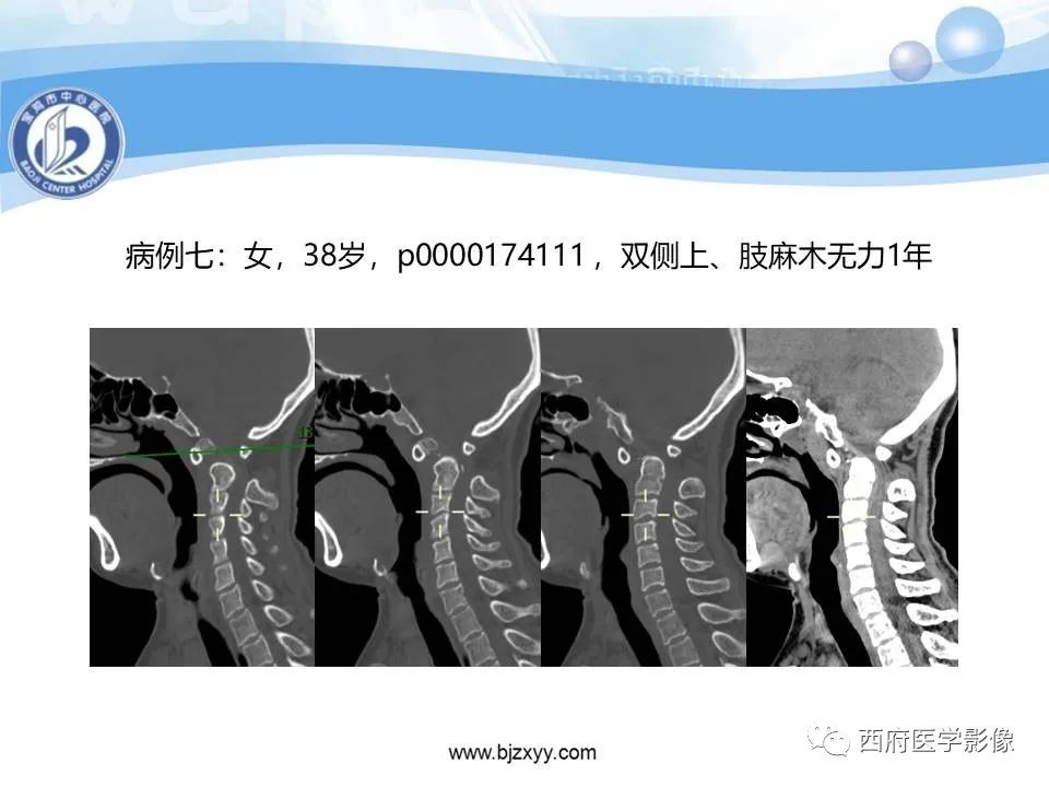 影像PPT - 【PPT】颅底凹陷症的影像诊断-40