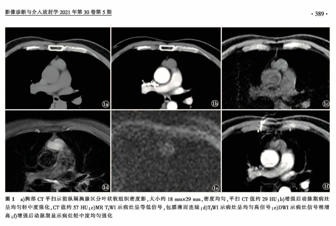 影像PPT - 【病例】胸腺肿物—类癌1例影像诊断思维-4