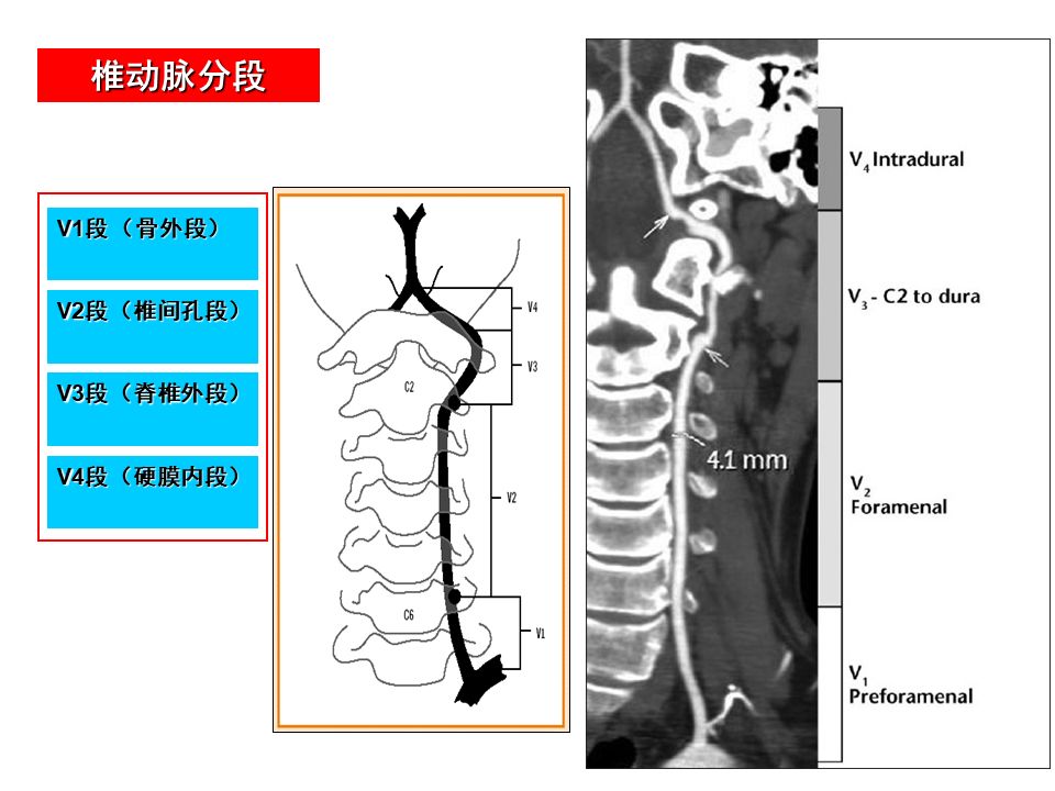 影像PPT - 【PPT】脑动脉分段解析-11