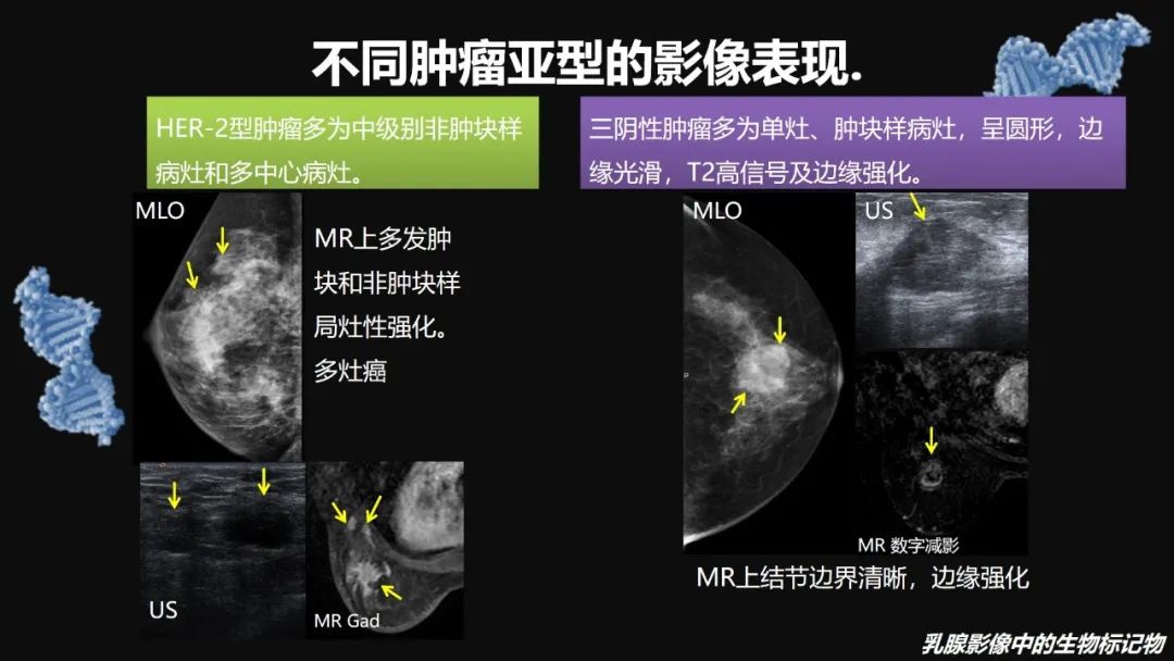 影像PPT - 【PPT】​乳腺影像中的生物标记物-54