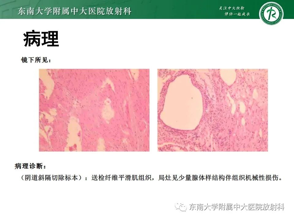 影像PPT - 【PPT】阴道斜隔综合征-4