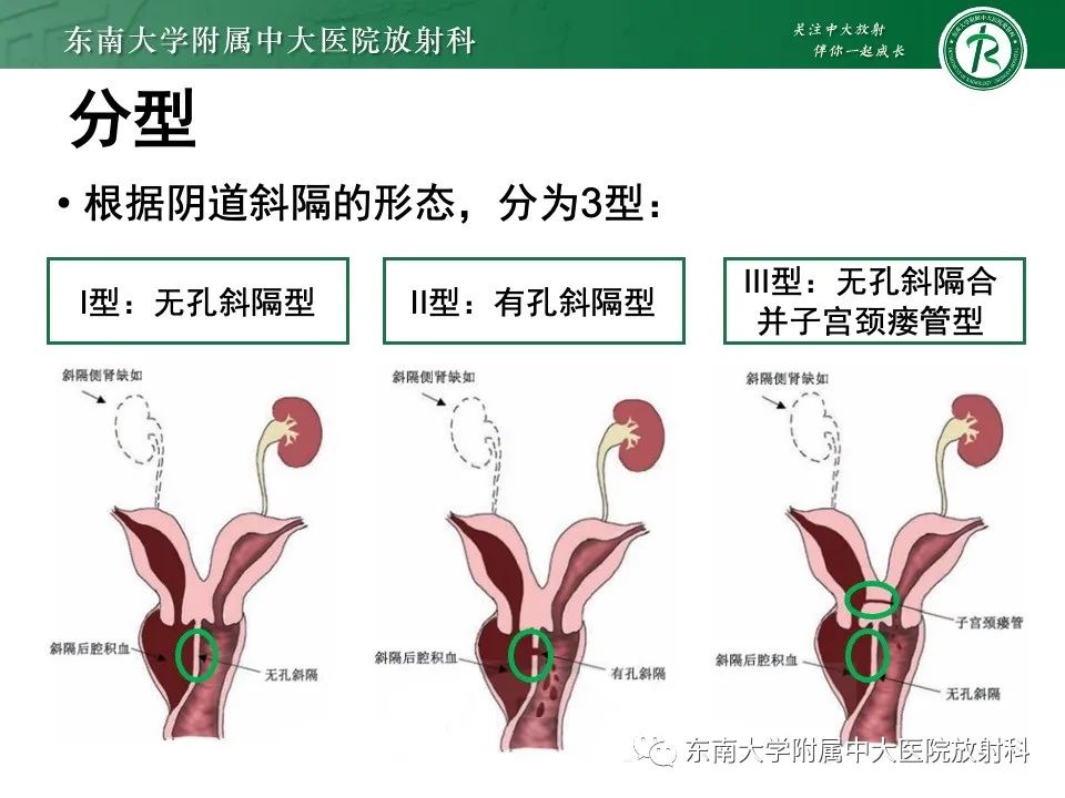 影像PPT - 【PPT】阴道斜隔综合征-7
