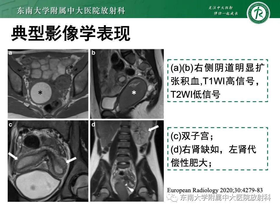 影像PPT - 【PPT】阴道斜隔综合征-12