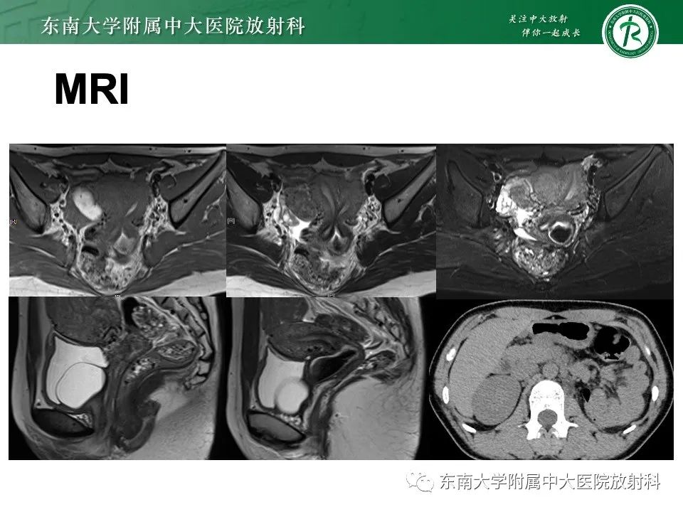 影像PPT - 【PPT】阴道斜隔综合征-14