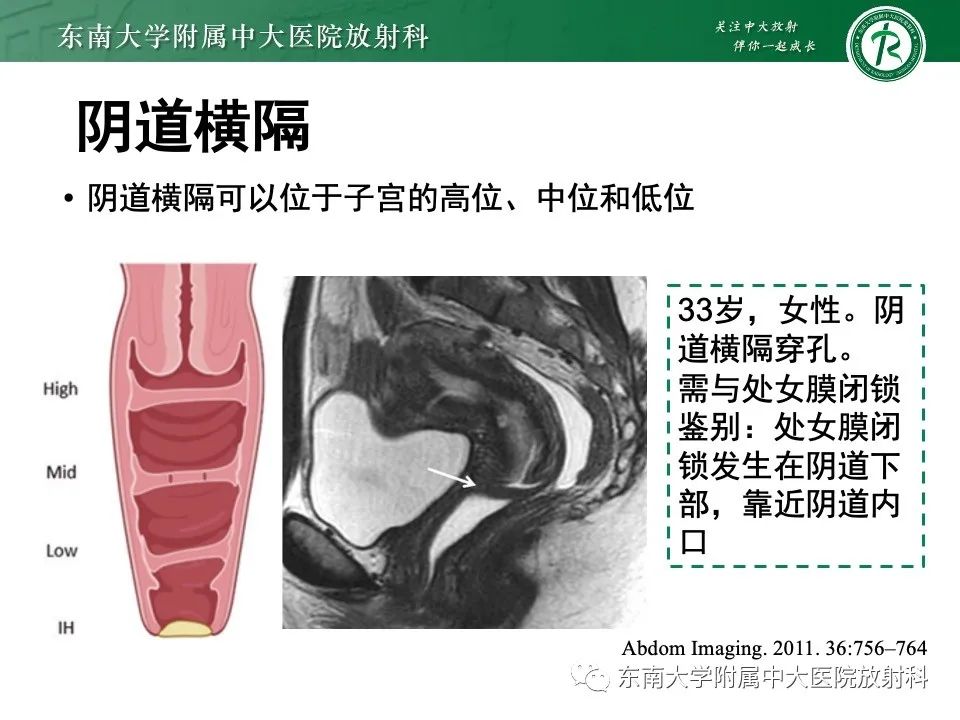 影像PPT - 【PPT】阴道斜隔综合征-17