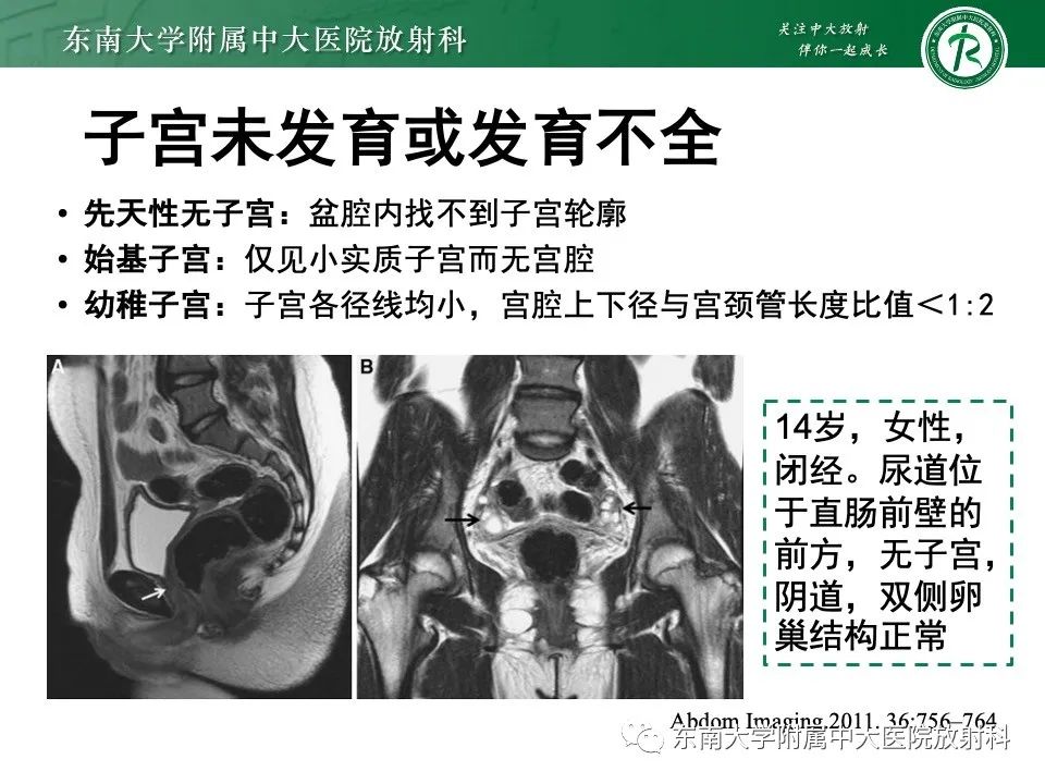 影像PPT - 【PPT】阴道斜隔综合征-19