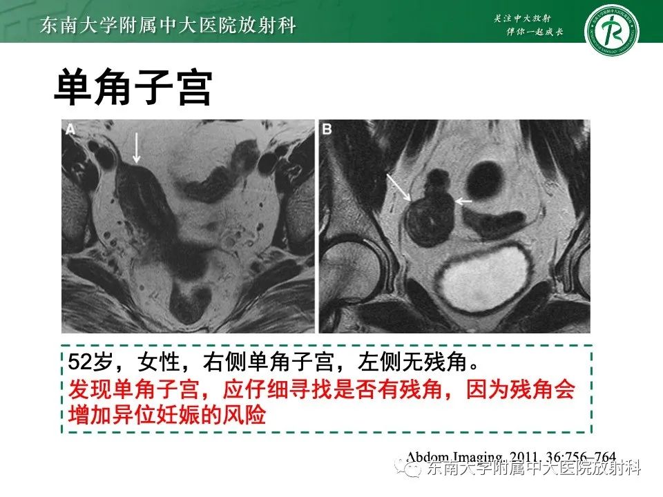 影像PPT - 【PPT】阴道斜隔综合征-21