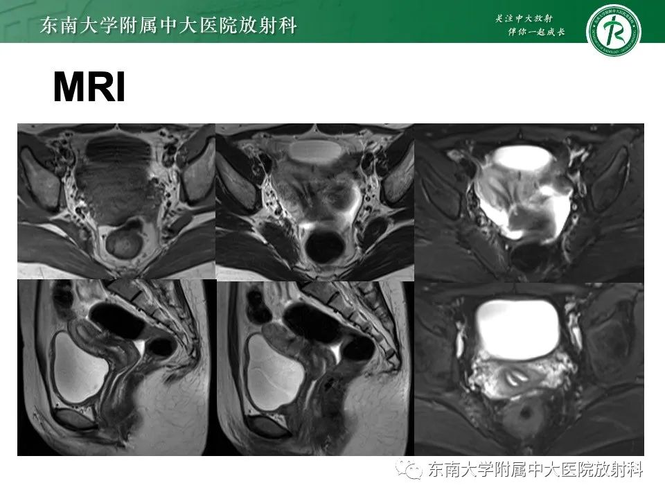 影像PPT - 【PPT】阴道斜隔综合征-25