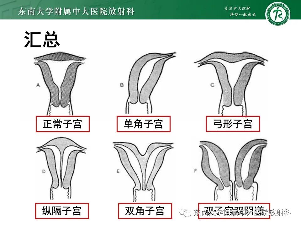 影像PPT - 【PPT】阴道斜隔综合征-28