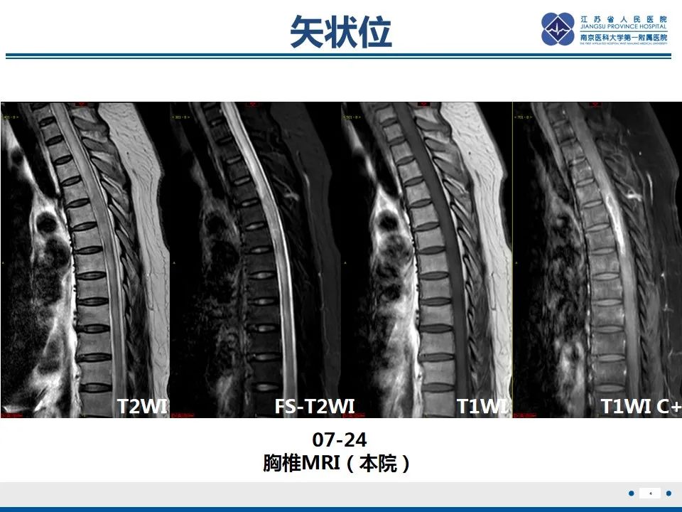 影像PPT - 【PPT】脊髓内脓肿-5