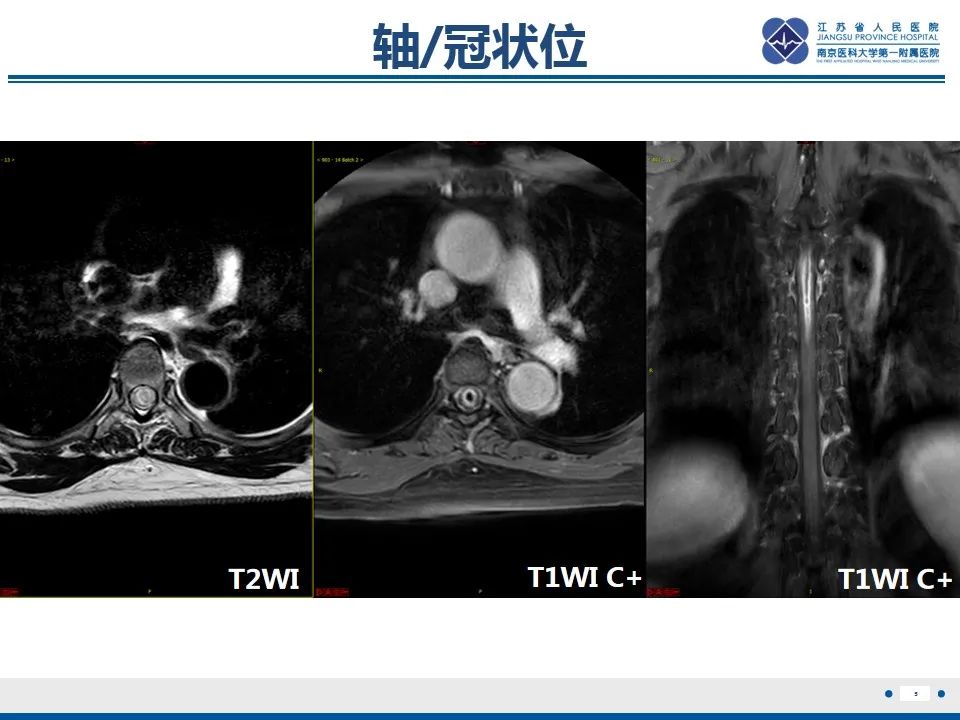 影像PPT - 【PPT】脊髓内脓肿-6