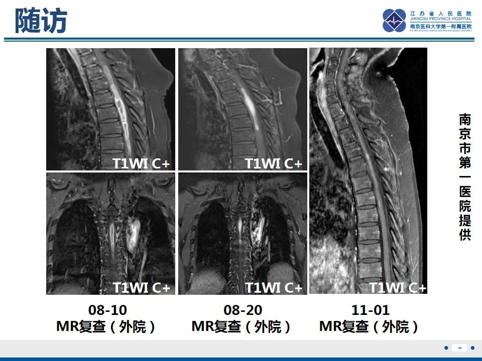 影像PPT - 【PPT】脊髓内脓肿-21
