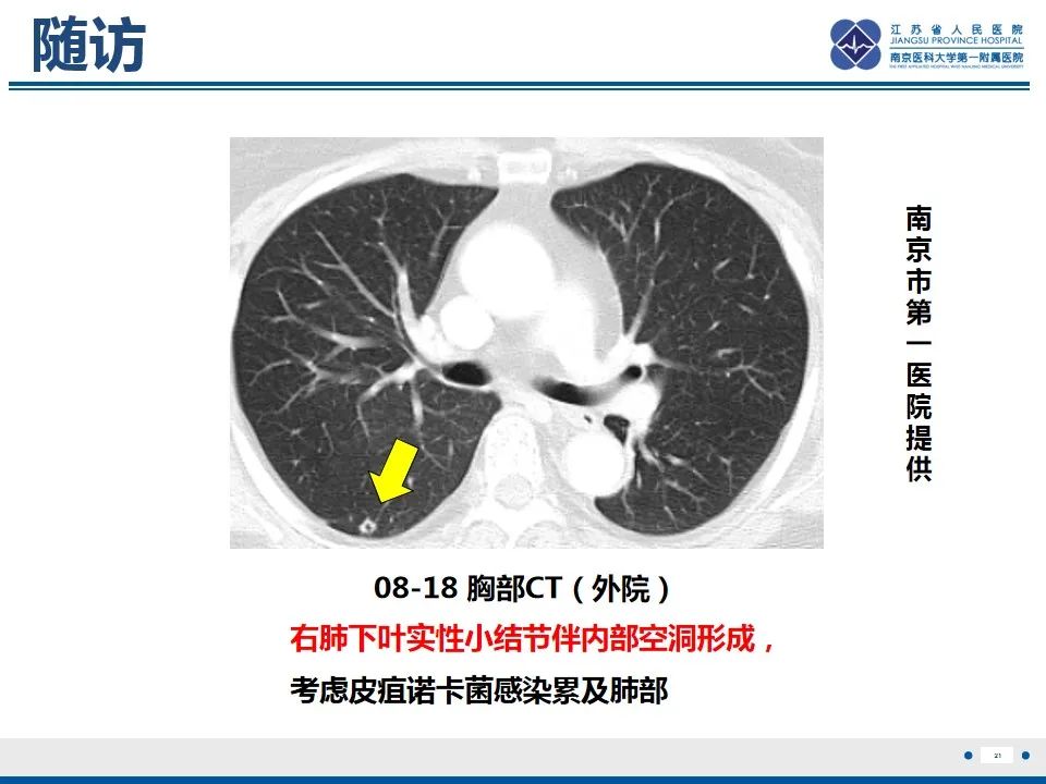 影像PPT - 【PPT】脊髓内脓肿-22