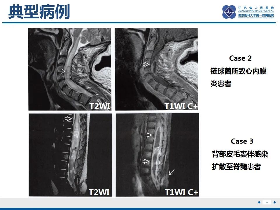 影像PPT - 【PPT】脊髓内脓肿-30