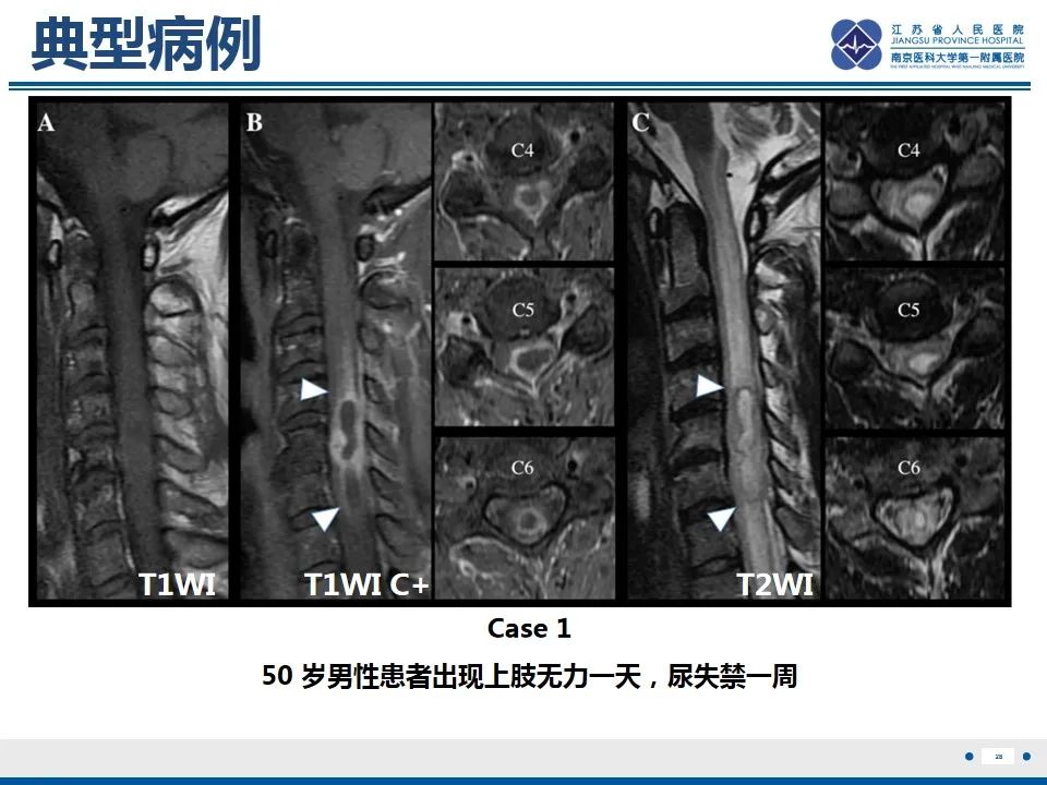 影像PPT - 【PPT】脊髓内脓肿-29
