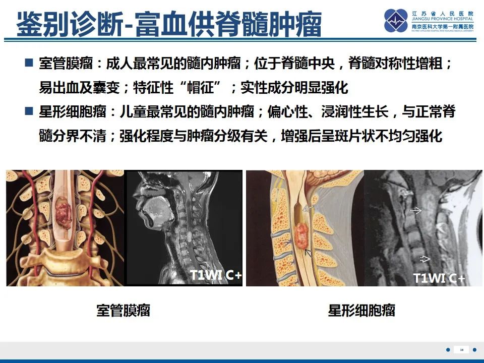 影像PPT - 【PPT】脊髓内脓肿-39